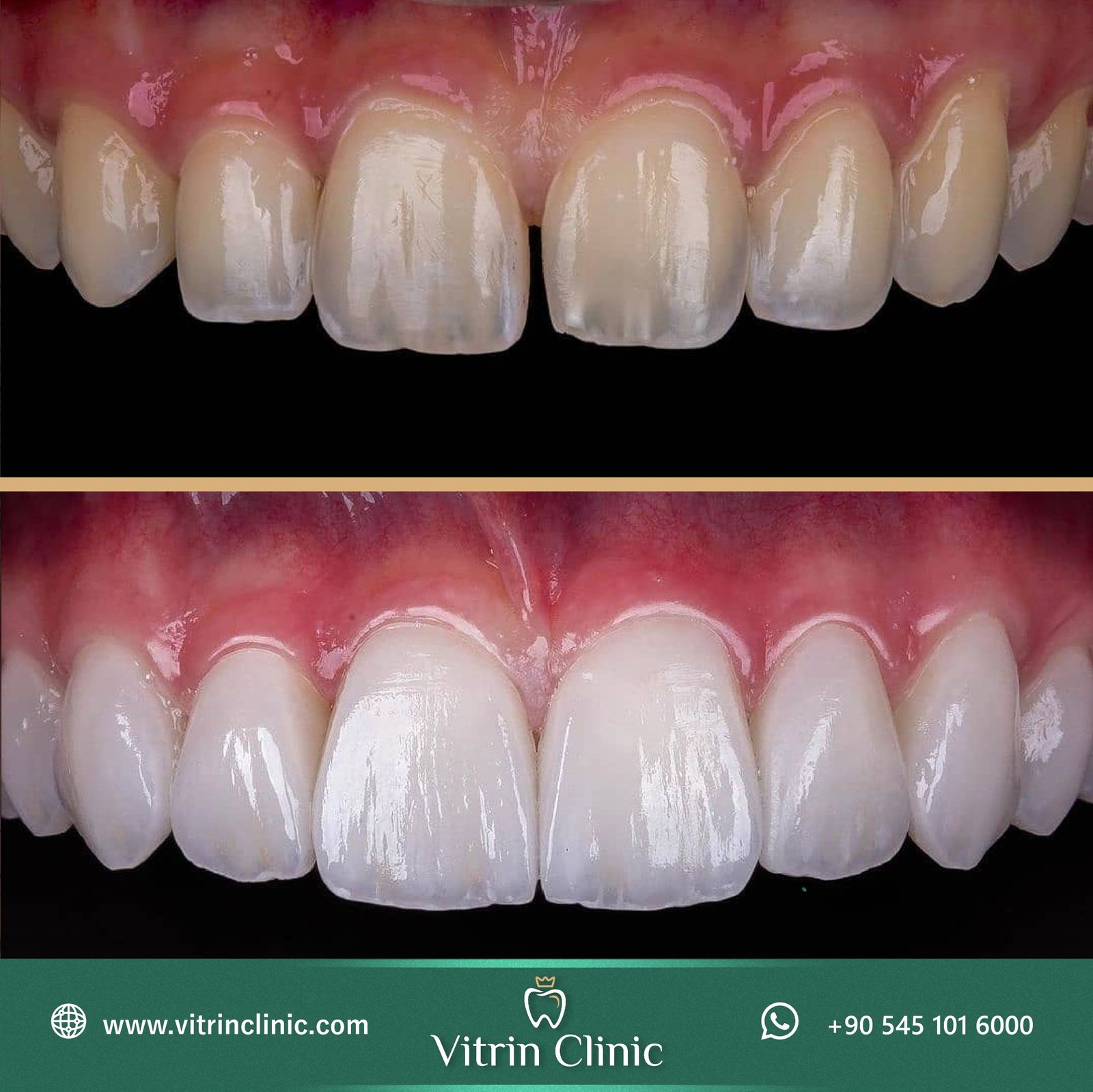 Best-Hollywood-Smile