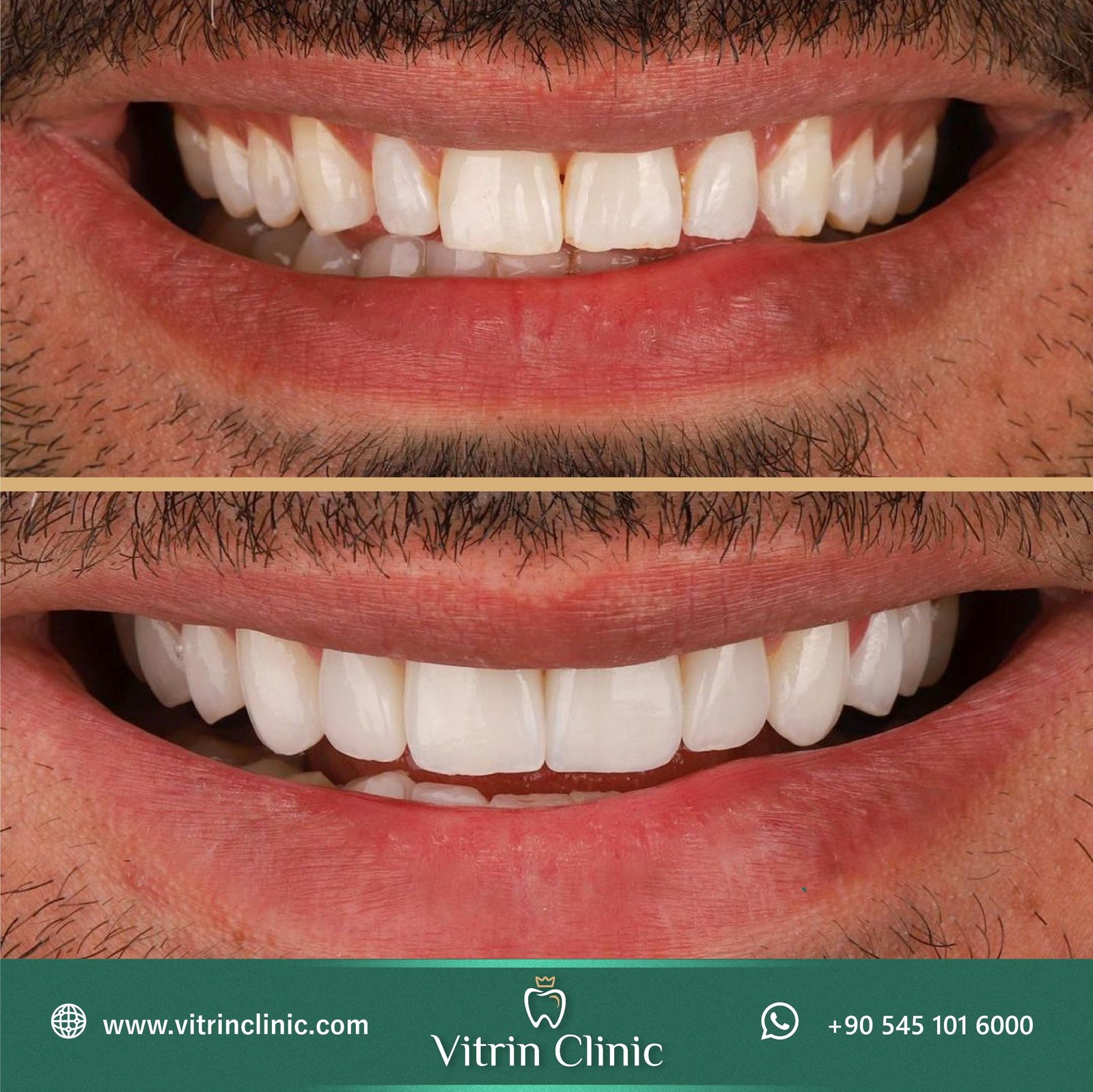 hollywood smile teeth